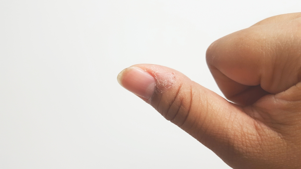 Paronychia or a soft tissue infection around a thumb on white background.