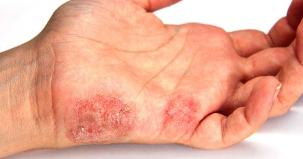 What Is Tinea Manuum? (Causes, Treatment, and More) - Featured image