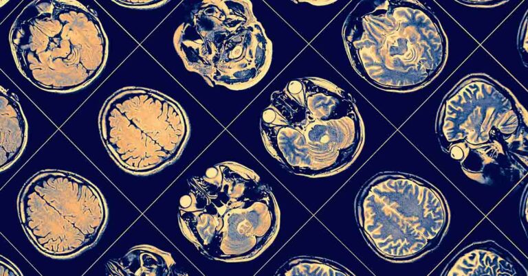 Man With 90% of His Brain Damaged Defies Expectations, Lives Normally - Featured image