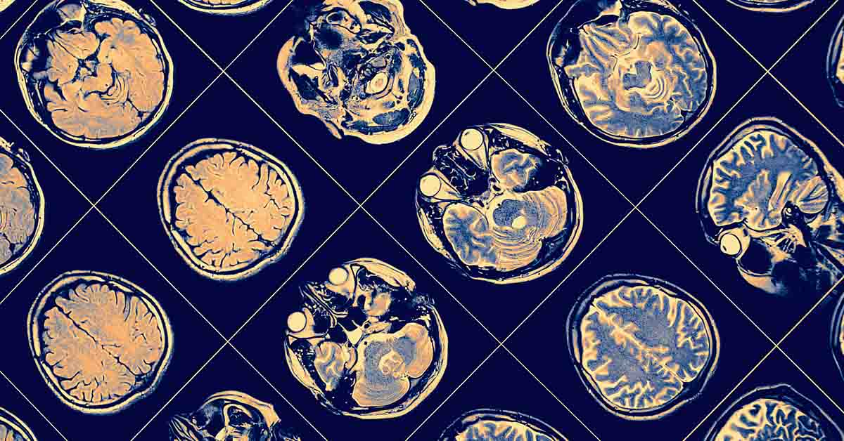 Man With 90% of His Brain Damaged Defies Expectations, Lives Normally