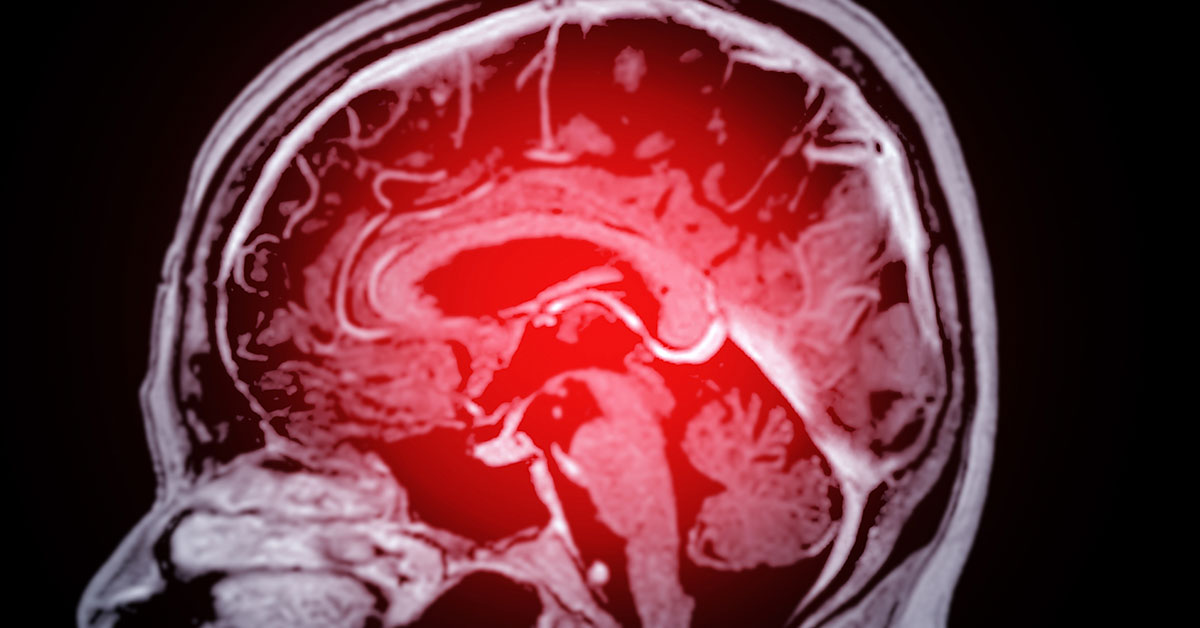 4 Dementia Symptoms You Might Notice Before Memory Loss Sets In