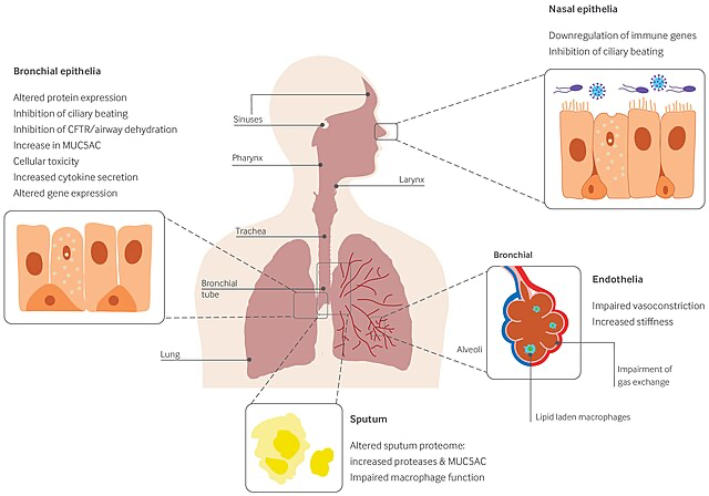 Detailed medical illustration showing how vaping affects different parts of the respiratory system, including the bronchial passages and cellular changes that occur with extended exposure.