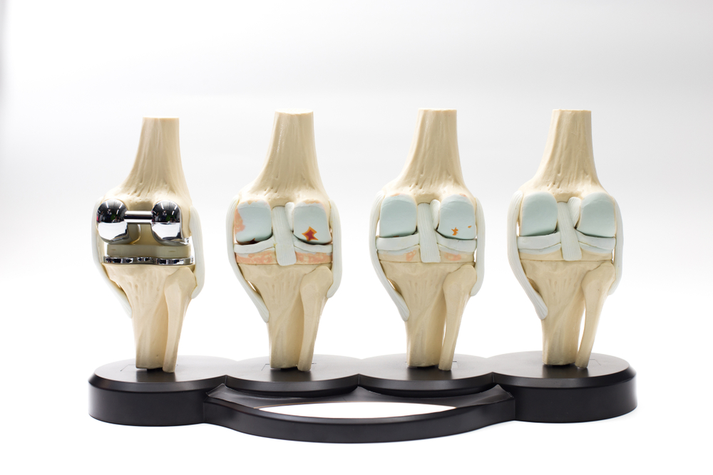 model of knee joint showing multiple stages of knee osteoarthritis and total knee replacement. on white background. Located on the base
