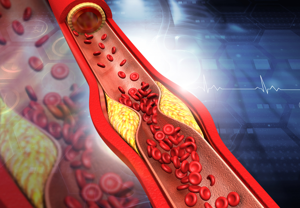 10+ Signs You’re Living With Clogged Arteries - Featured image