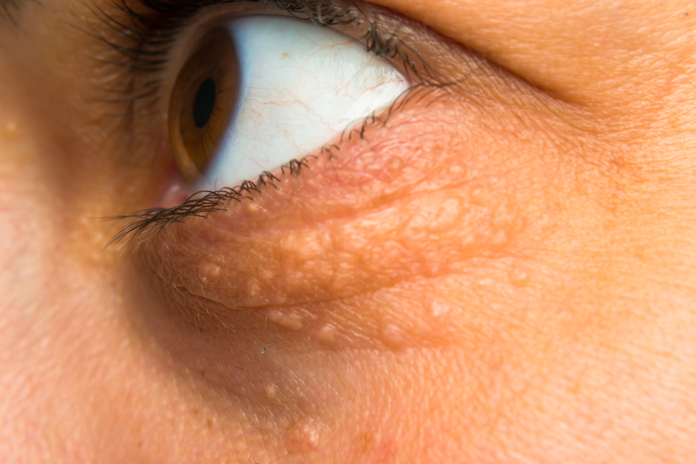 close-up photo of a women face with fat points near eye
