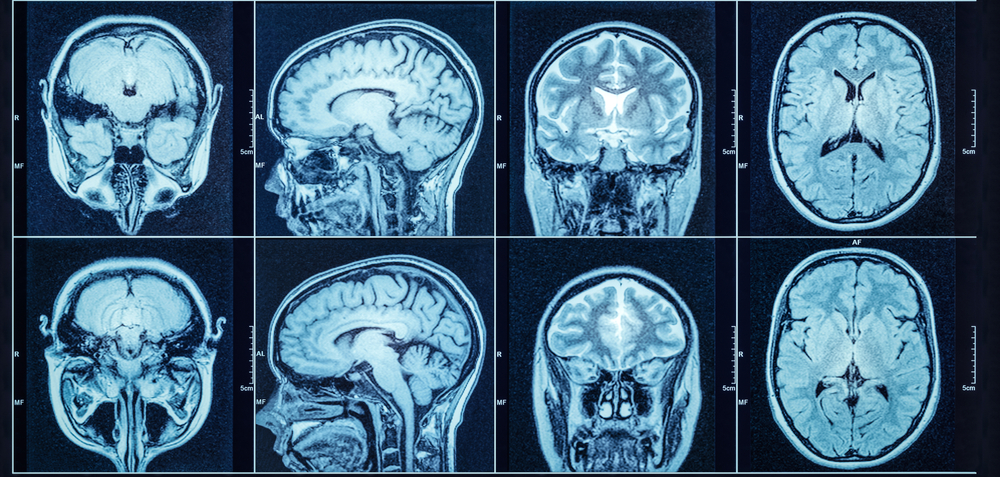 Closeup of a CT scan with brain. Medical, science and education mri brain background. Magnetic resonance imaging.