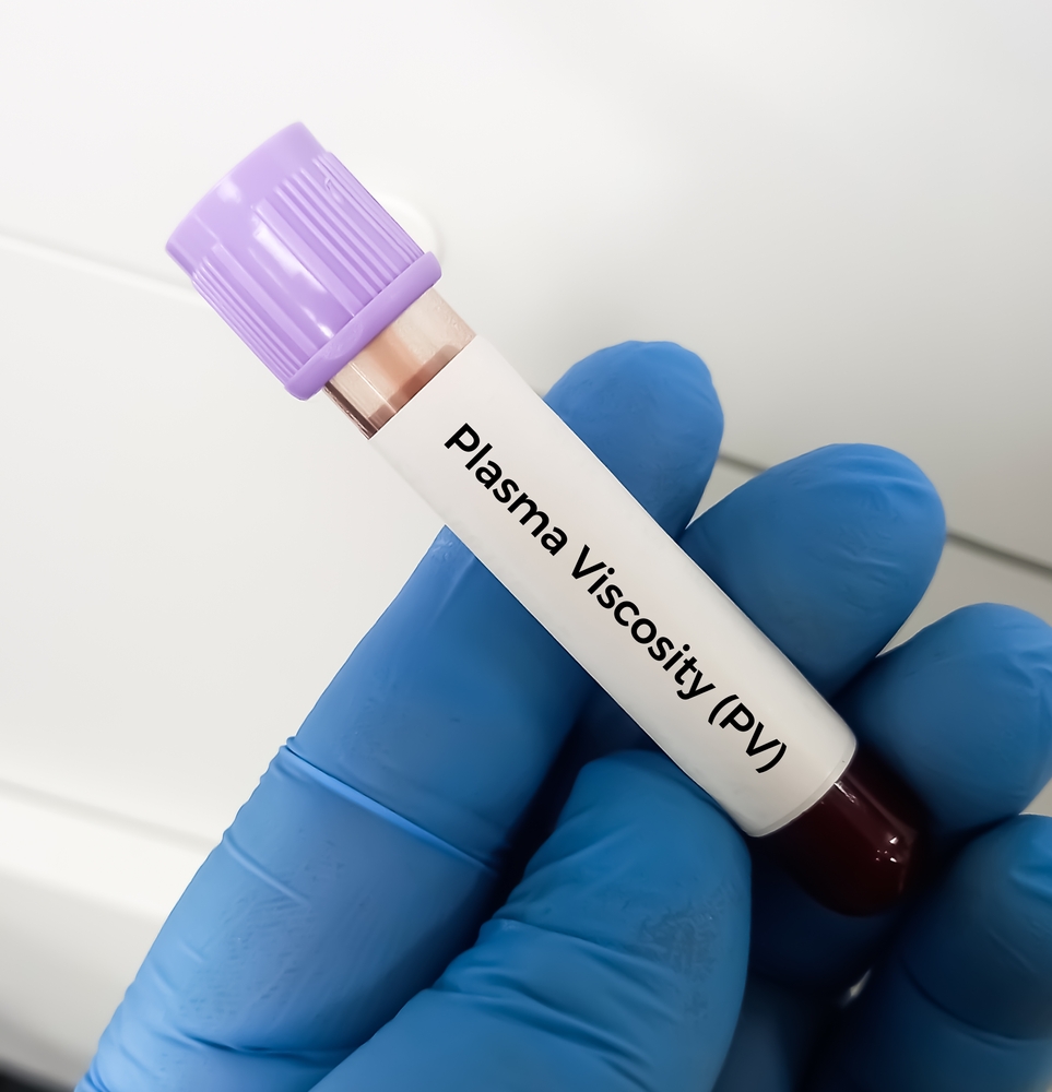 Blood sample for Plasma Viscosity (PV) test, Diagnosis for Polymyalgia rheumatica, giant cell arteritis