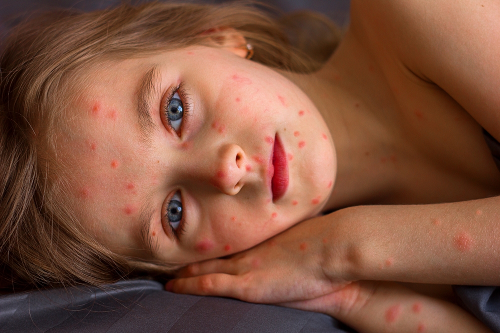 Red rash on the skin of a little girl, chicken pox and measles in children on the face close-up