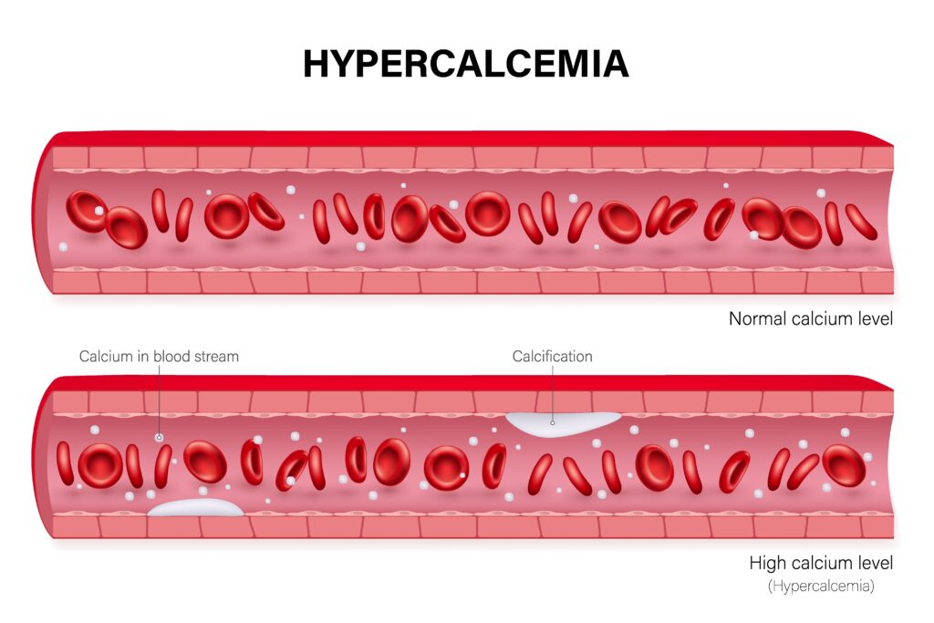 Hypercalcemia vector. Comparison between Normal calcium level and High calcium level. Calcium in blood vessel.