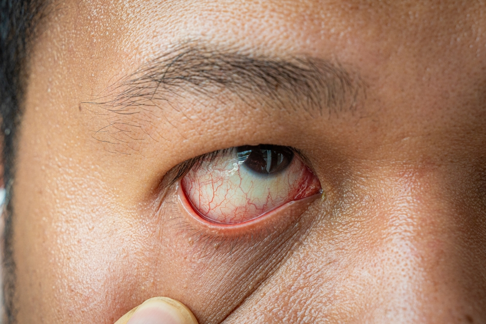 Close-up of severe hemorrhagic conjunctivitis.
