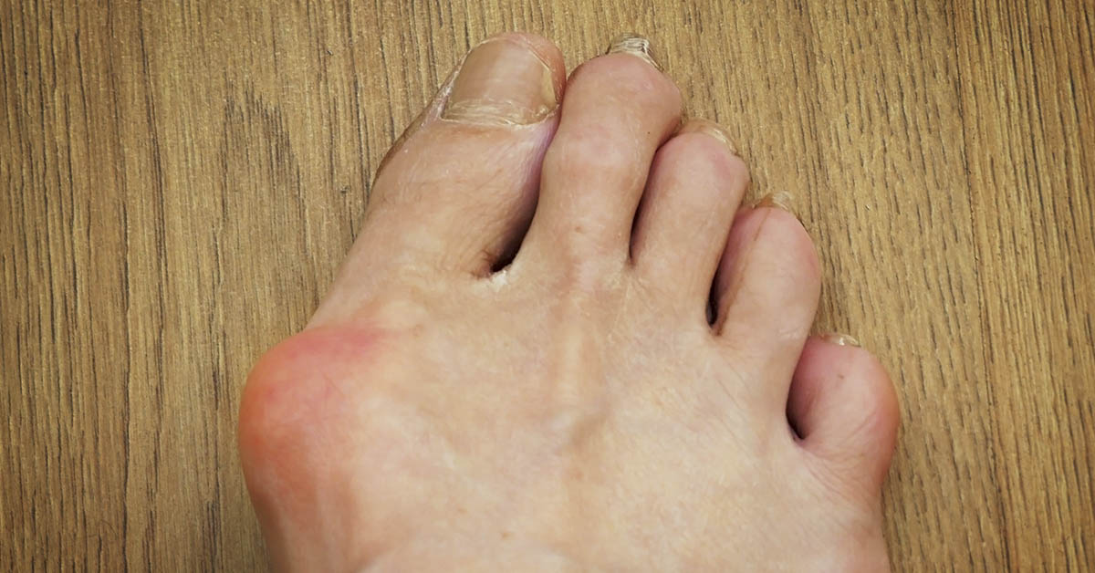 Why Do We Have Bunions? You Can Blame Evolution.