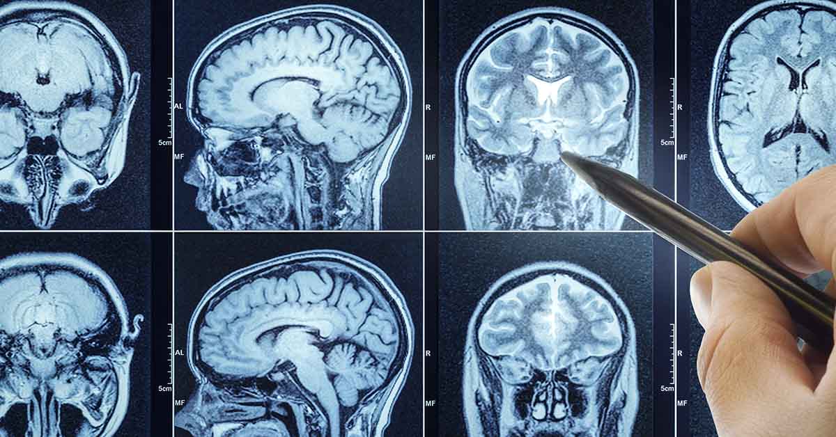 30-Second Hand Test Reveals Signs of a Hidden Brain Tumor, Says Doctor