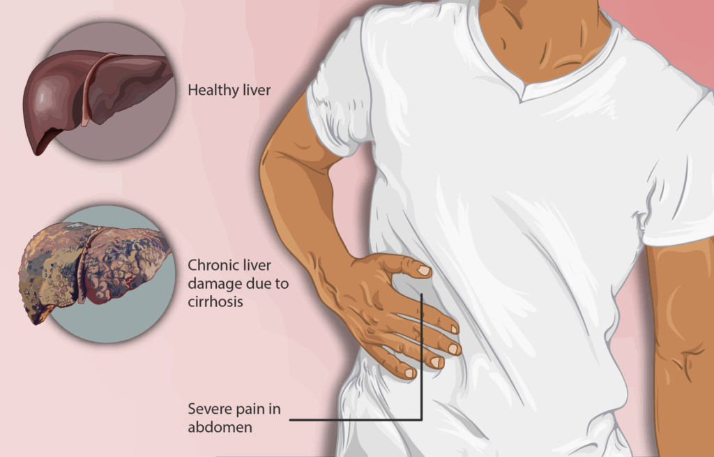 Medical illustration comparing healthy liver to cirrhosis-damaged liver with person experiencing abdominal pain.