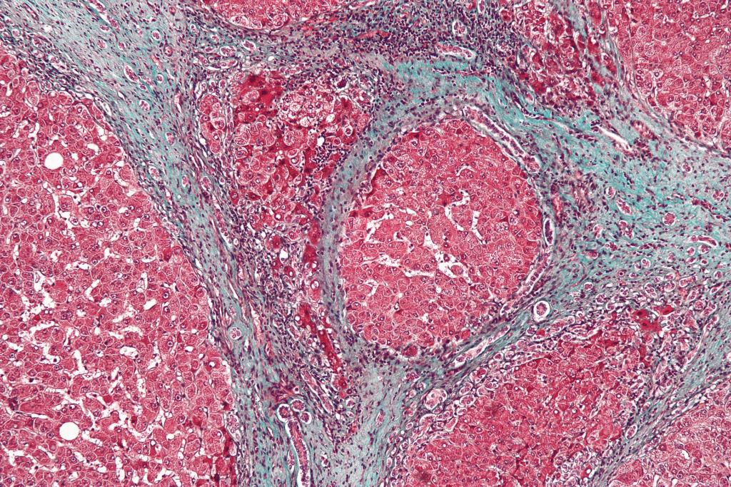 Microscopic view of liver tissue showing cellular structure and fibrosis patterns during liver recovery after drinking.