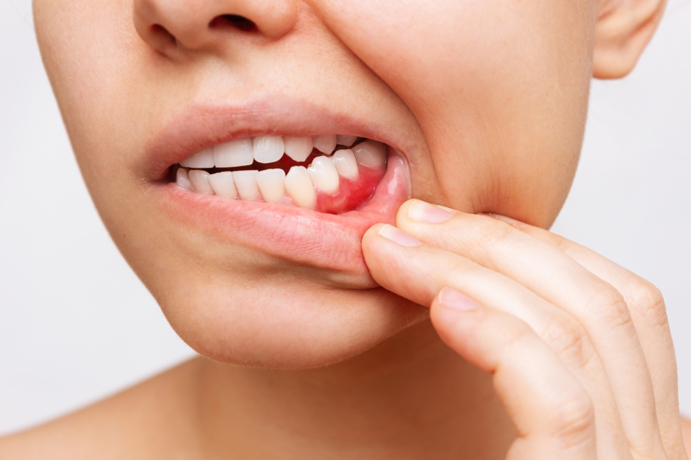Gum inflammation. Cropped shot of a young woman showing red bleeding gums isolated on a white background. Close up. Dentistry, dental care	