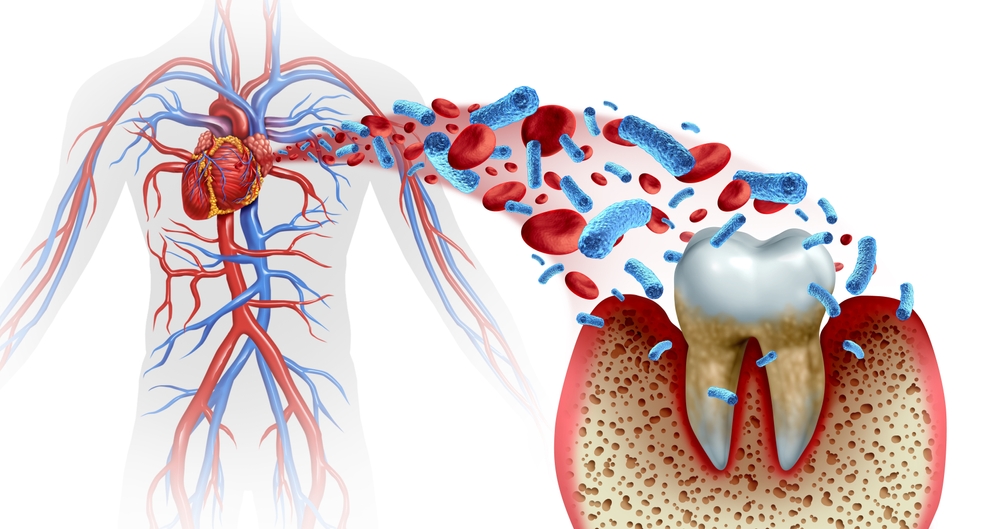 Tooth decay and heart disease as an unhealthy molar with periodontitis due to poor oral hygiene health problem as bacteria infection in the blood as a concept with inflammation as a 3D illustration.