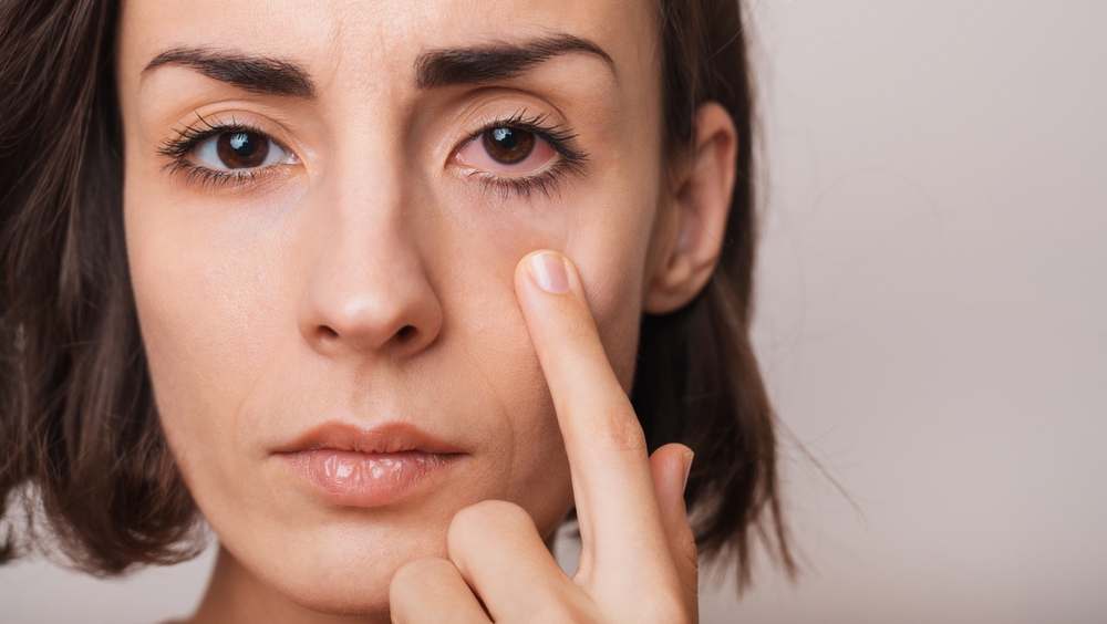 Close up of red eye before and after treatment or eye drop. Tired eyes and contact lenses. Dry eye, depression, sick, virus, sleepy.
