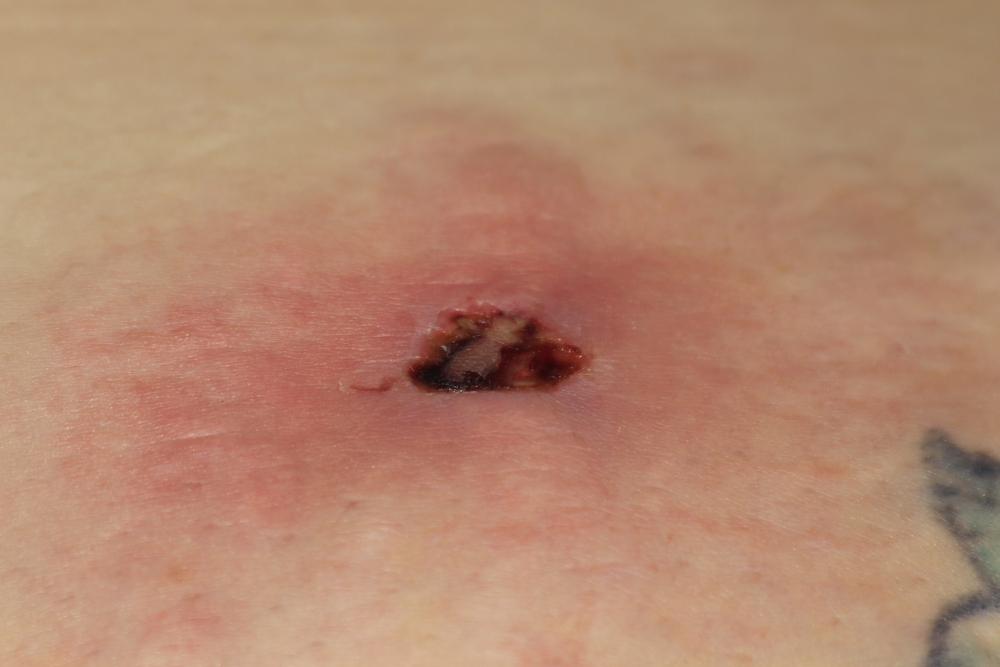 A Brown Recluse spider bite shot closeup thats red in the center, and a red rash on the out side of it. Shot in Kansas.
