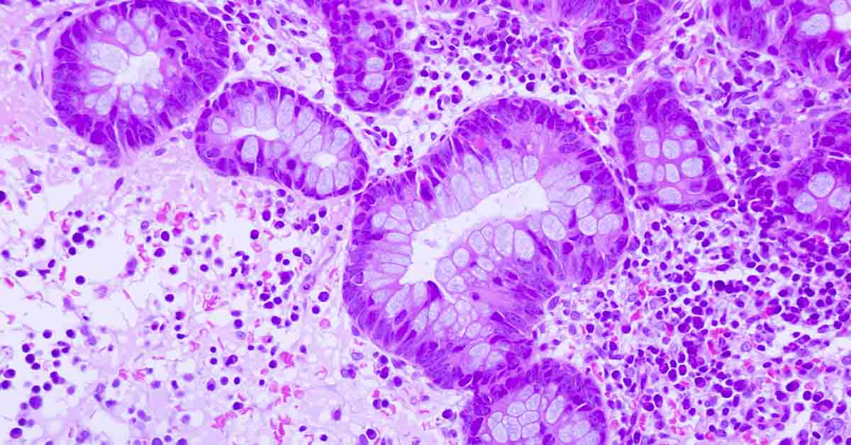 Eye-Opening Simulation Shows How Cancer Progresses Toward Death