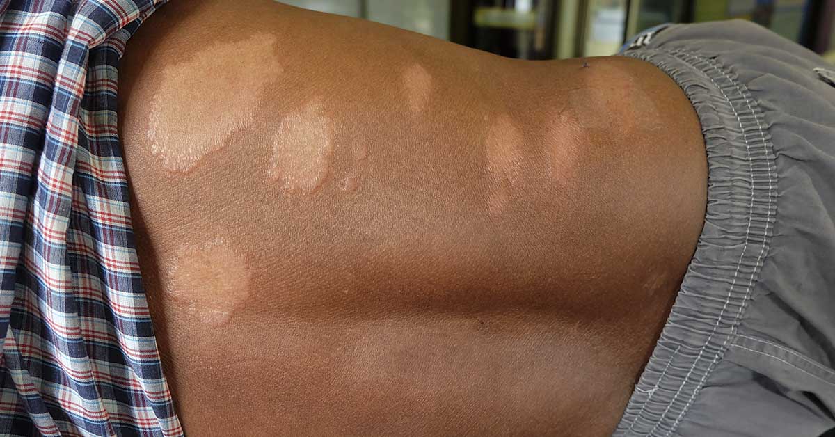 Scientists Uncover Bizarre Clues About Where Leprosy Really Came From