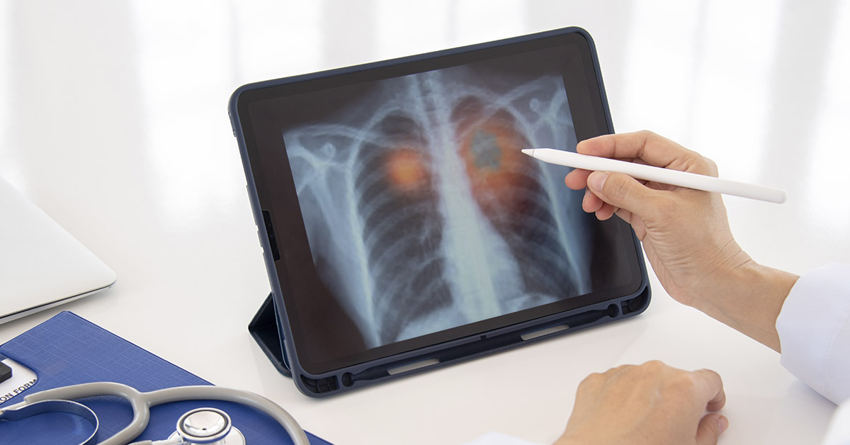 Seven Countries Join Forces to Test Groundbreaking Lung Cancer Vaccine
