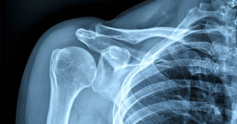 Scientists Develop Injectable Hydrogel to Strengthen Bones - Featured image