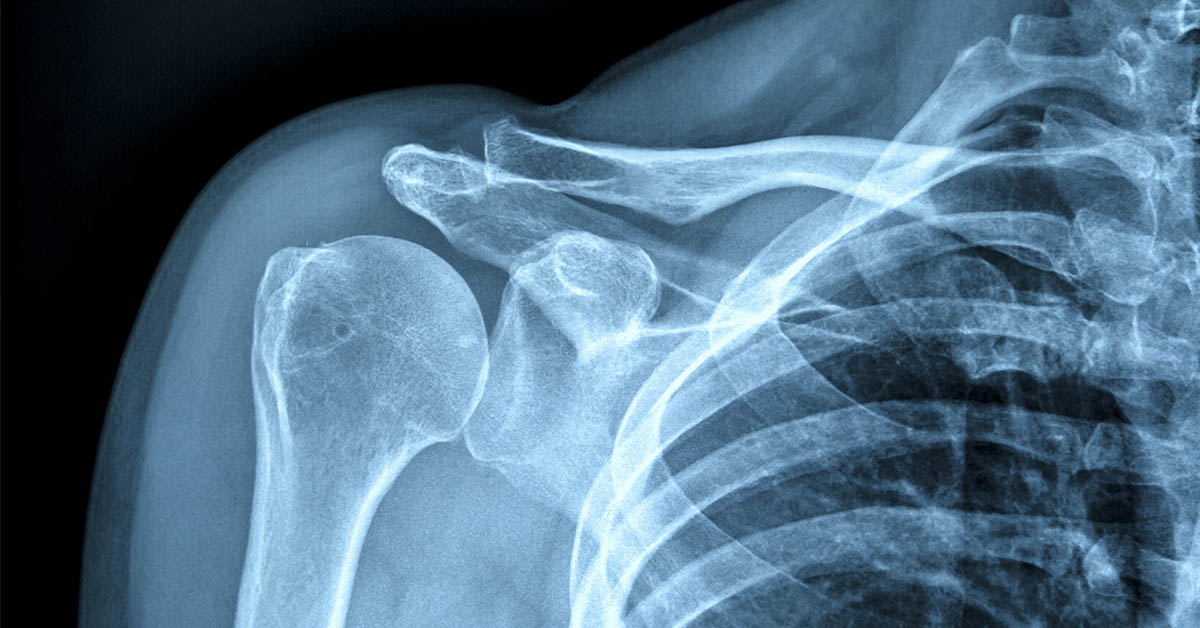 Scientists Develop Injectable Hydrogel to Strengthen Bones