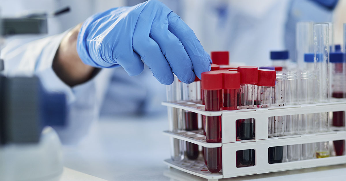 Johns Hopkins Blood Test Detects Tumor DNA Up to Three Years Early