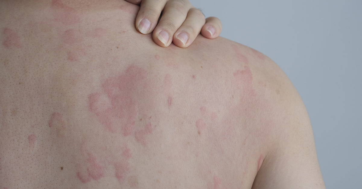 8 Surprising Triggers of Hives You Might Not Expect