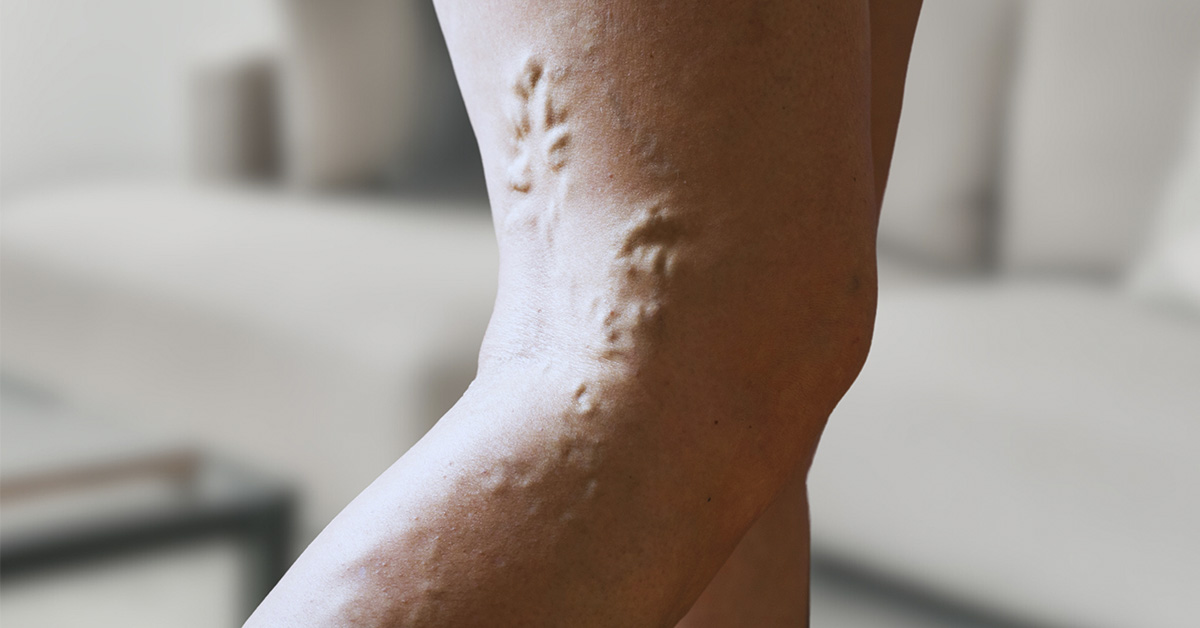 Hidden Triggers of Deep Vein Thrombosis You Should Know