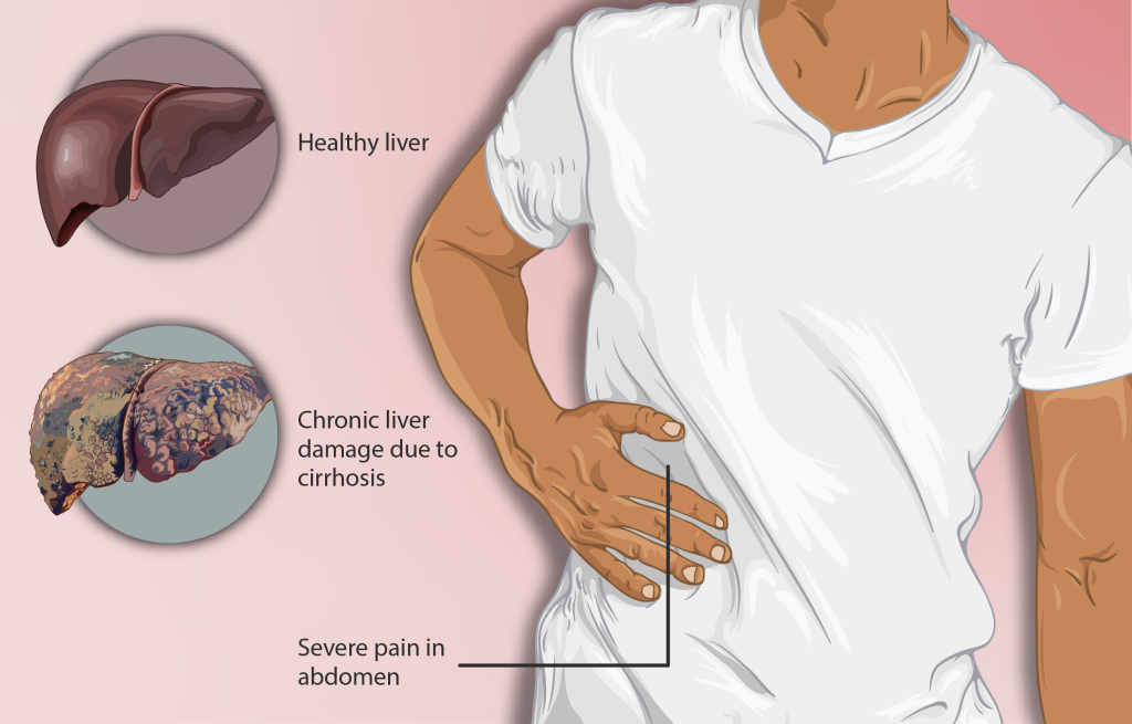 illustration showing a healthy liver and chronic liver disease. 