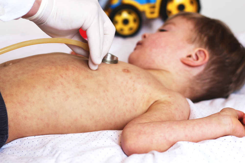 Viral disease. Measles rash. Concept doctor and patient. Child with viral infection measles and doctor with stethoscope
