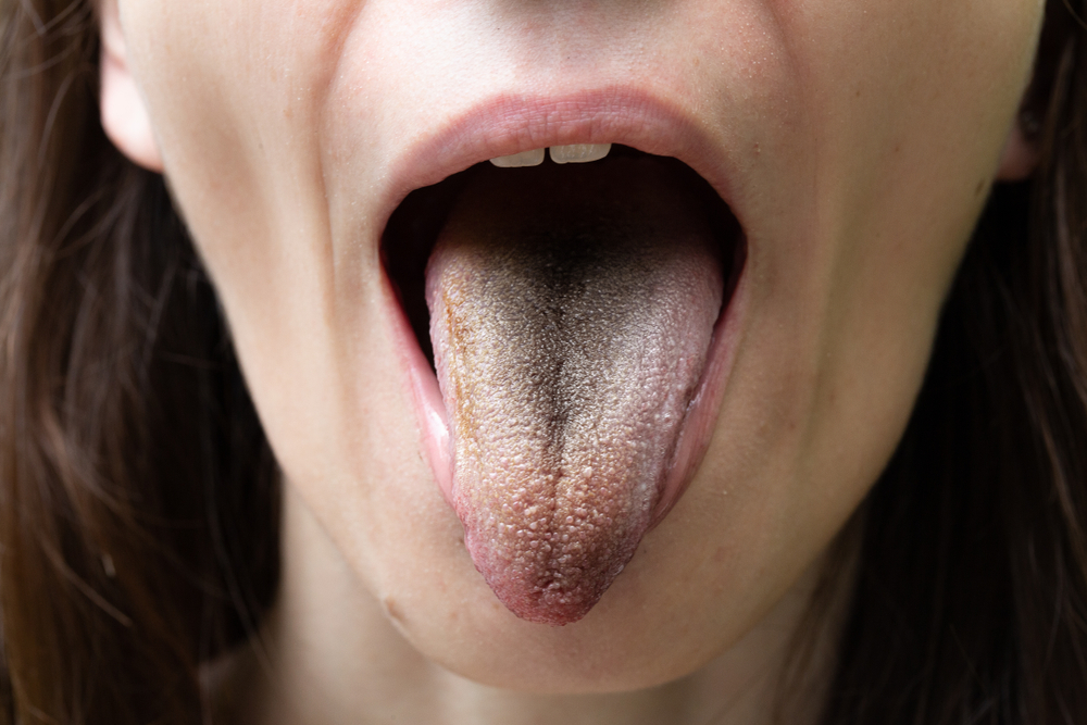 A close up view on the mouth of a thirty something girl, opening her mouth to reveal symptoms of a bacterial infection. Black hairy tongue.
