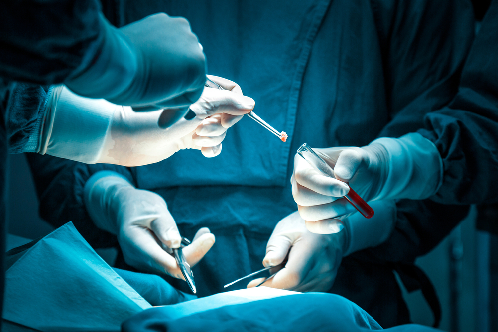 concentrated professional surgical doctor team operating surgery a patient in the operating room at hospital. tumor cancer. surgical biopsy specimens. healthcare and medical concept.
