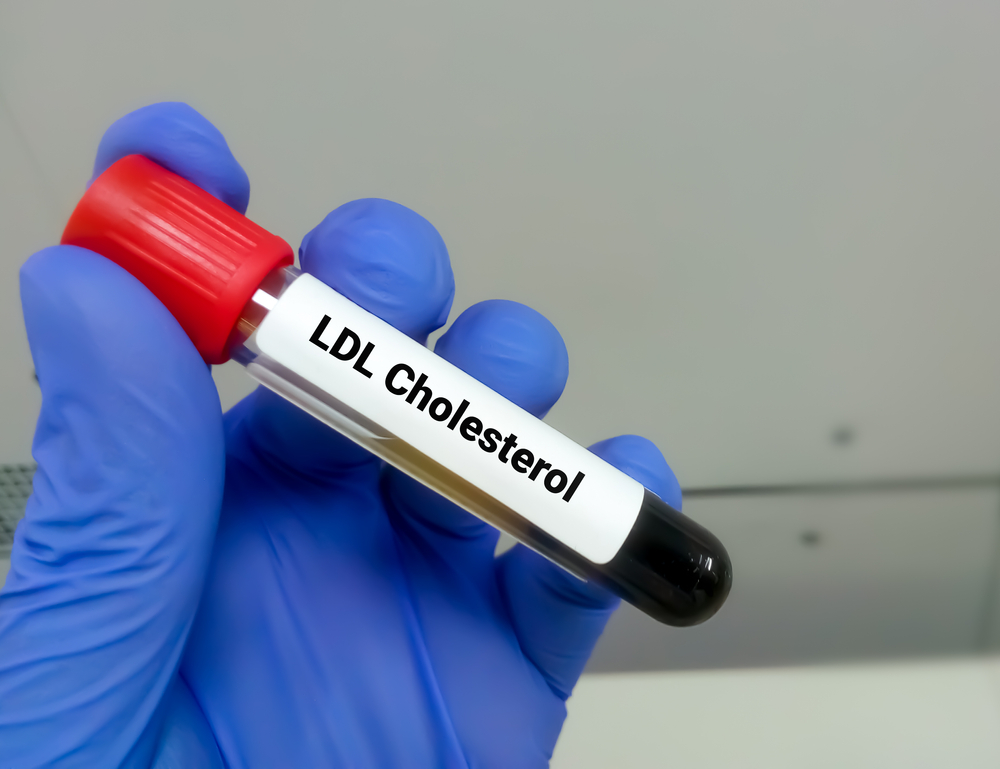 Blood sample for LDL cholesterol test, LDL-C, Bad cholesterol

