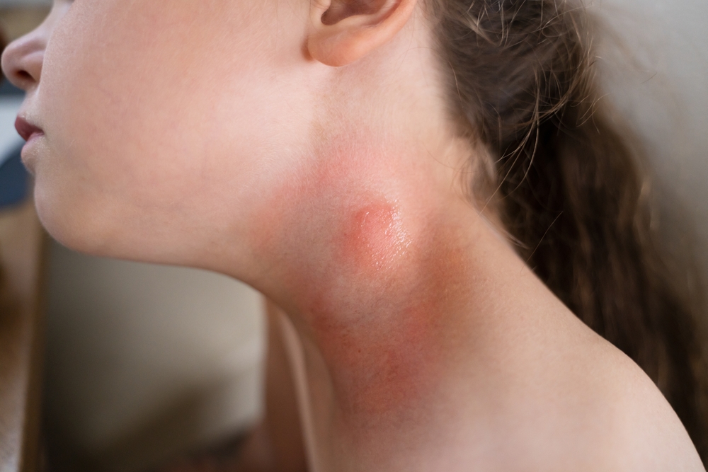 Encephalitis Mite Bug Or Arachnid Parasite Under Child Skin
