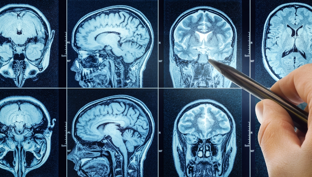 CT scan with brain and doctor's hand. Medical, science and mri brain background. Magnetic resonance imaging. The doctor is doing a brain test.
