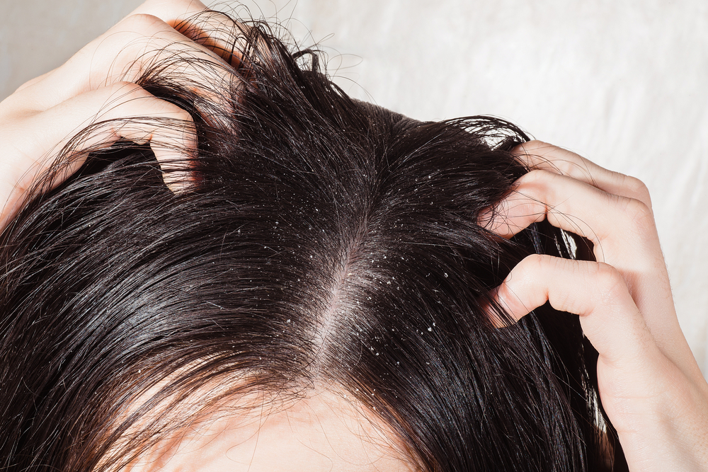 Dander that causes itching scalp
