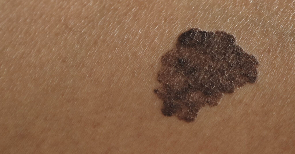 Rare But Deadly Skin Cancers That People Often Overlook - Featured image