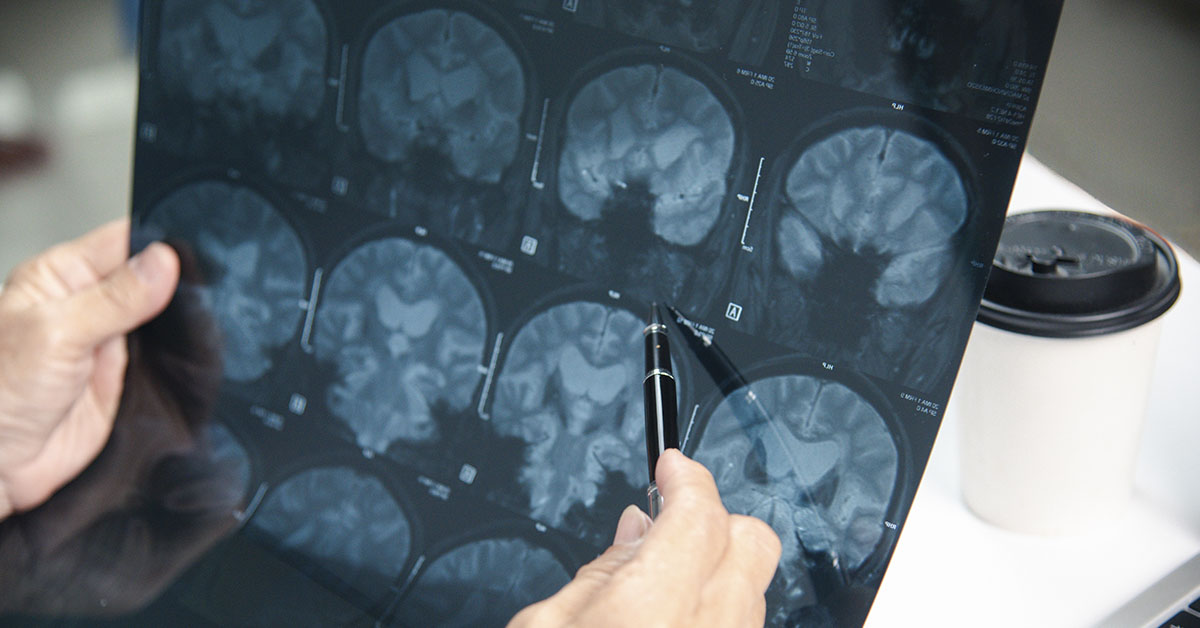 Deadly Brain Tumor Disappears After Experimental Cancer Treatment