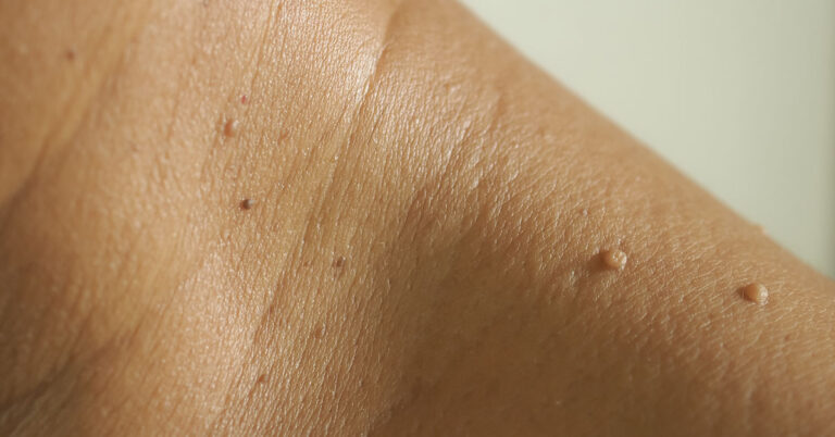 Experts Explain Why Flesh-Colored Moles Appear on the Neck and Armpits - Featured image