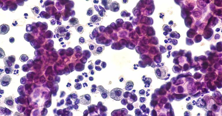 Cancer Cells Self-Destruct – Thanks to This Deep-Sea Sugar - Featured image