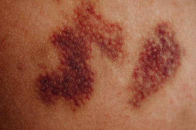 bruise on skin