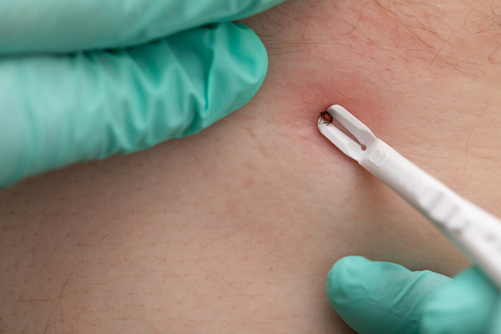 Close up picture human hand holding tweezers , removing tick from human skin