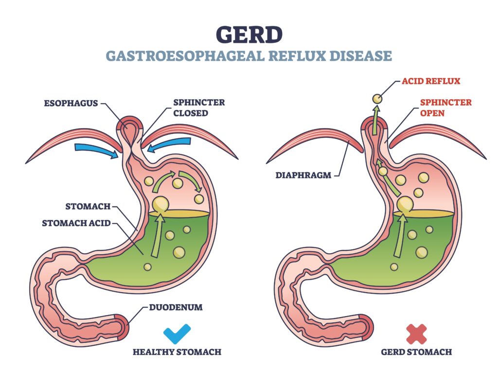 GERD or gastroesophageal reflux disease with digestive acid outline diagram. Labeled educational scheme with medical heartburn feeling cause and compared with healthy process vector illustration.
