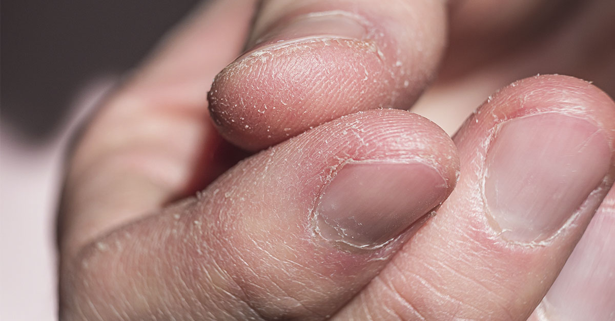 Hand Dermatitis: Causes, Conventional Treatments, and Natural Remedies