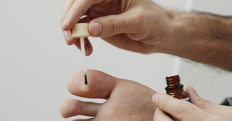 6 Types of Warts (Signs, Symptoms, Home Remedies, and Treatment) - Featured image