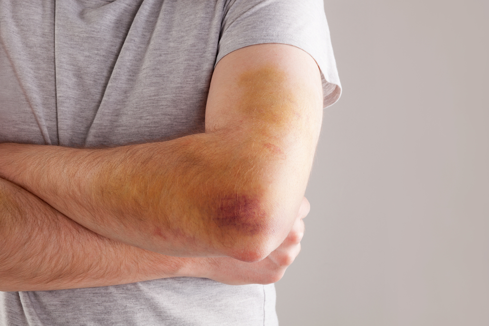Handsome man with big bruise on forearm, elbow and arm. Sport injury.