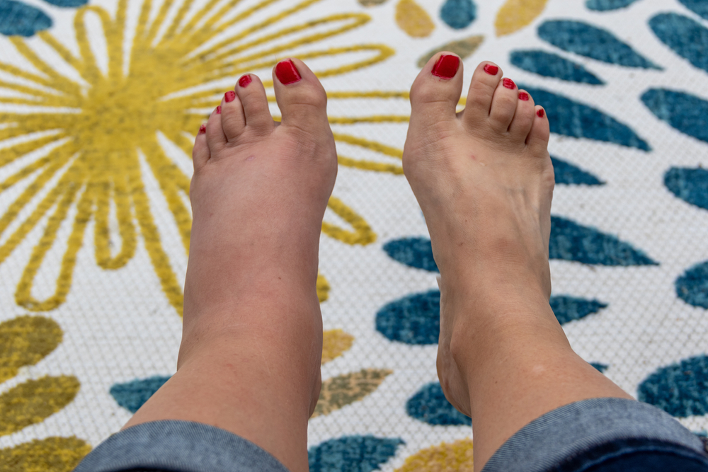 Swollen left foot comparison after wasp sting on female foot