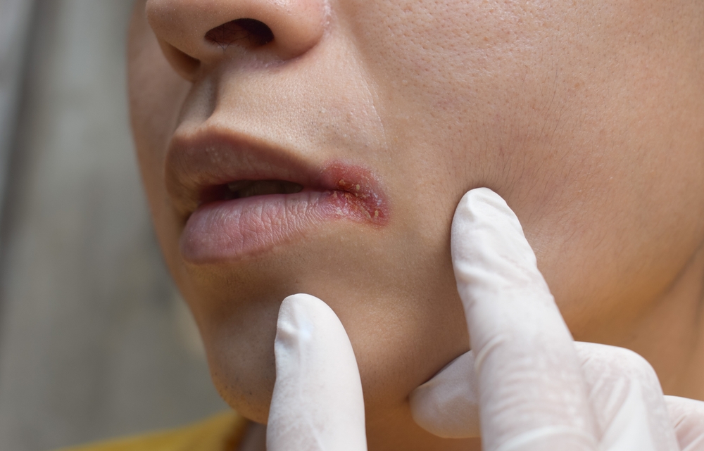 Angular stomatitis or angular cheilitis or perleche in asian young man. Common inflammatory condition caused by iron, zinc or B12 deficiency, or repetitive trauma.
